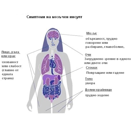 ИНСУЛТ