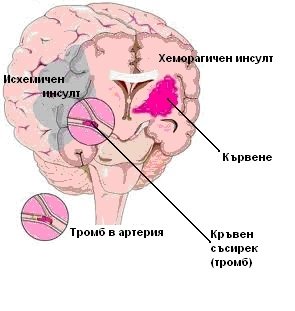 ИНСУЛТ