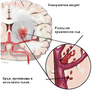 ИНСУЛТ