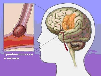 ИНСУЛТ