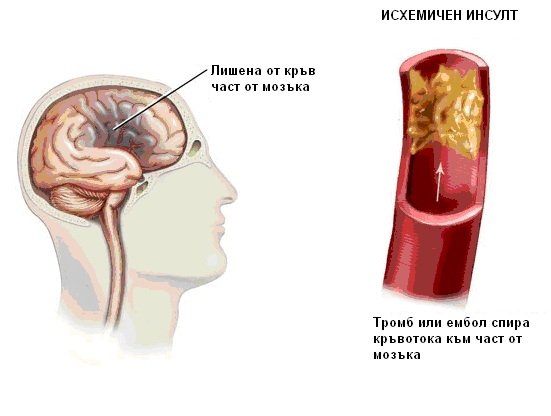 ИНСУЛТ
