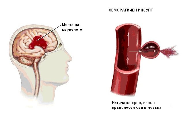 ИНСУЛТ
